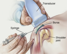 Subacromial bursal steroid injection