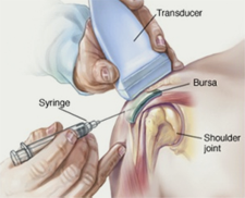 Knee joint injection steroid