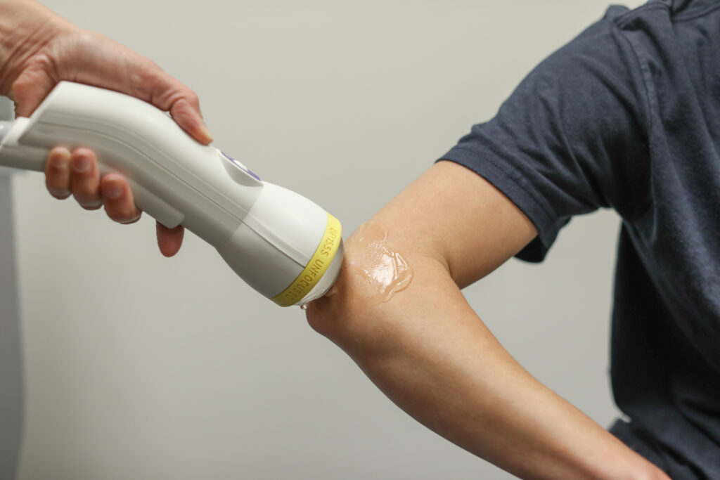 SoftWave Therapy being applied to a patient’s elbow to treat tendon pain using a non-invasive shockwave device